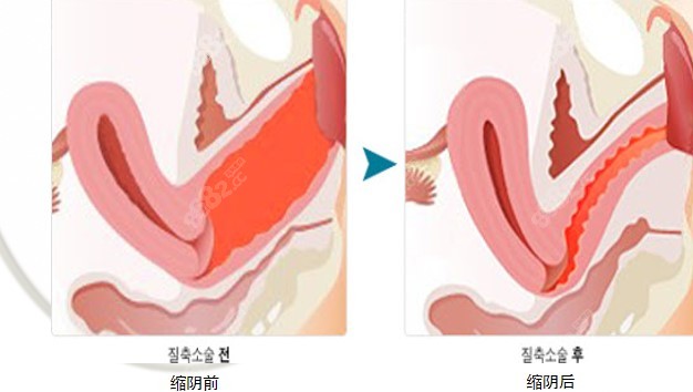 韩国Qline缩阴手术前后对比