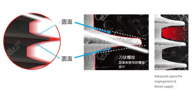 www.8682.cc提供韩国美格真种植体材质