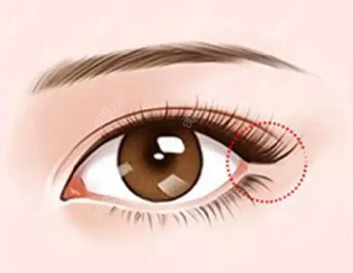 開外眼角睫毛下皮膚切掉了能長(zhǎng)好嗎