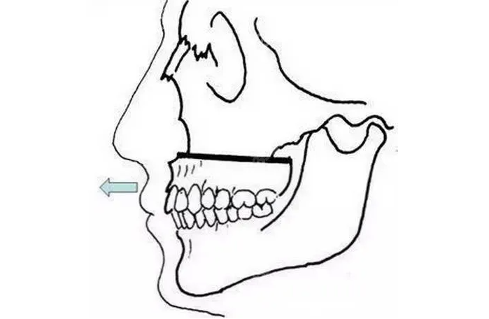 整牙对于面部的改善