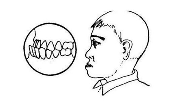 后牙反颌如何治疗