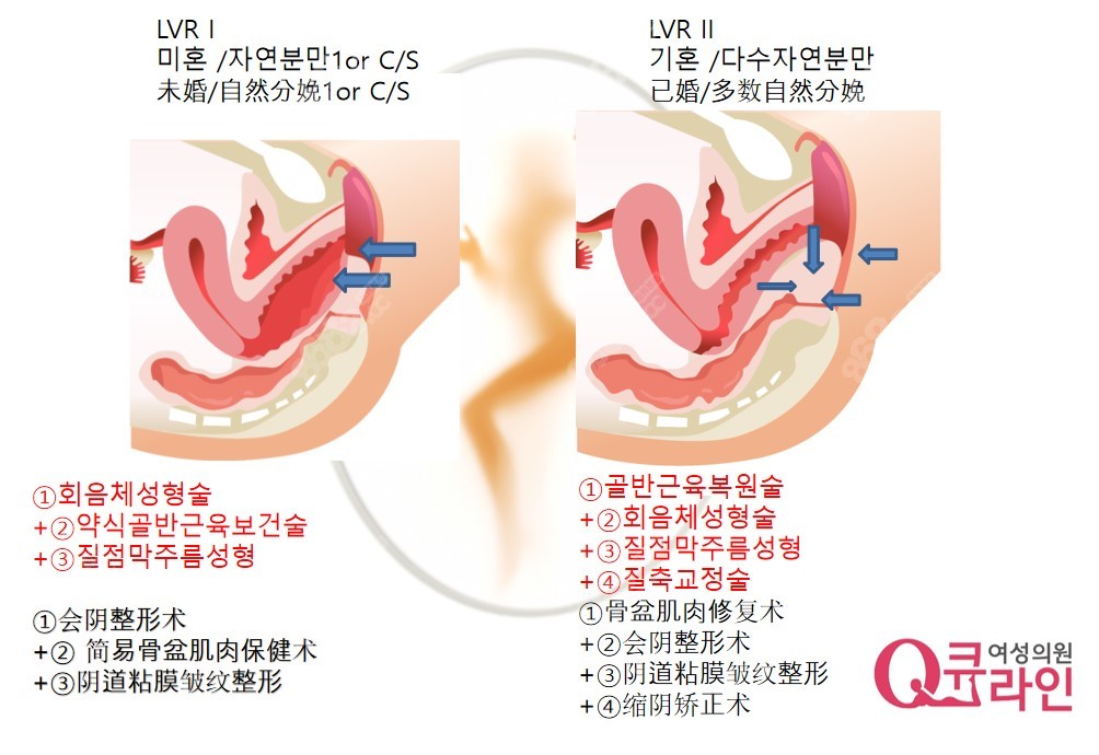 不同程度阴道松弛，在Qline可选择术式