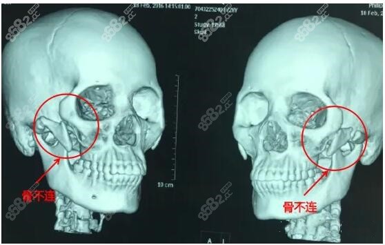 做颧弓颧骨手术后出现脸蛋下垂