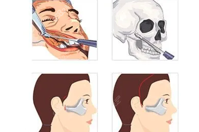 颧骨内推手术后遗症