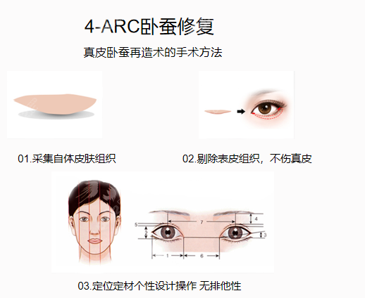 張冰潔醫(yī)生做自體真皮臥蠶怎么樣