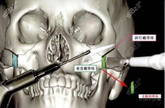 有人在削颧骨后脸型缩小并不明显