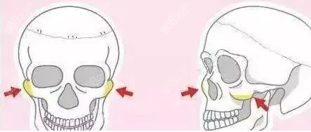 千万不要做颧骨手术的真实原因是