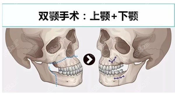 正颌/双鄂手术过程和操作步骤图片