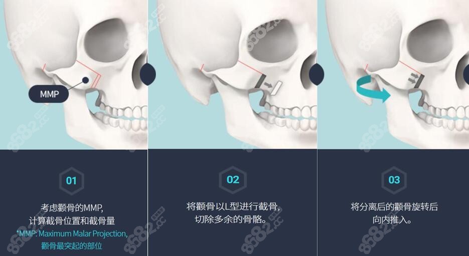 颧骨手术步骤示意图