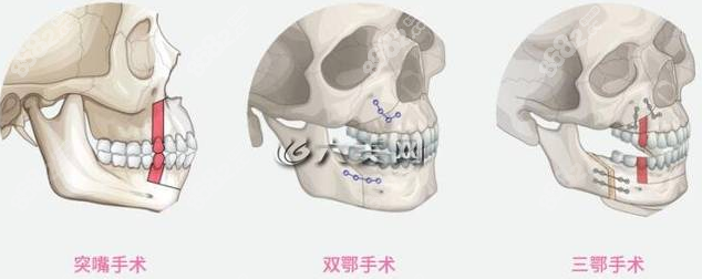 韩国双鄂手术