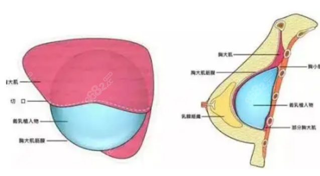 张亚梅医生隆胸怎么样？