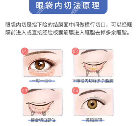 <!--<i data=20240705-sp></i>-->去眼袋可靠么