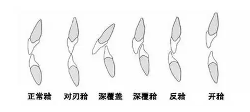 牙齿咬合关系