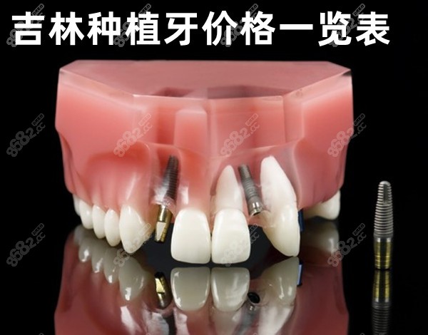 吉林种植牙价格一览表