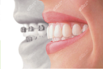 整牙可以只整上面一排吗