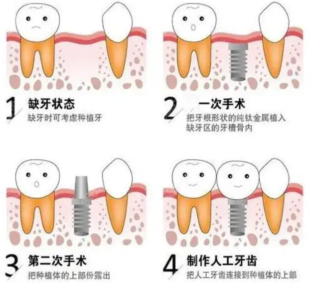 种植牙手术过程8682.cc