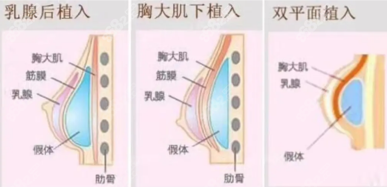 假体隆胸手术