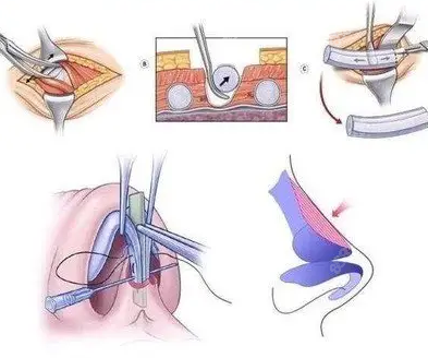 肋软骨隆鼻手术