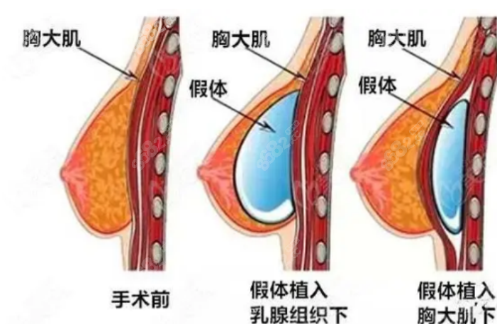 假体隆胸手术