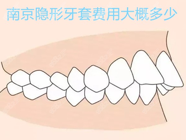 南京隐形牙套费用大概多少