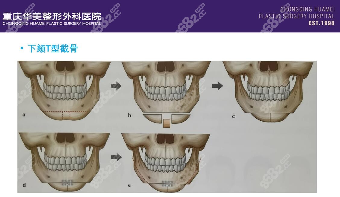 重庆颏成型手术推荐医院一 重庆华美颏成型8682 cc