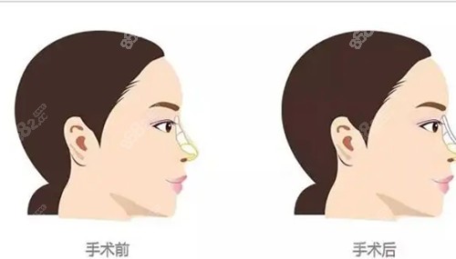 隆鼻技术优势