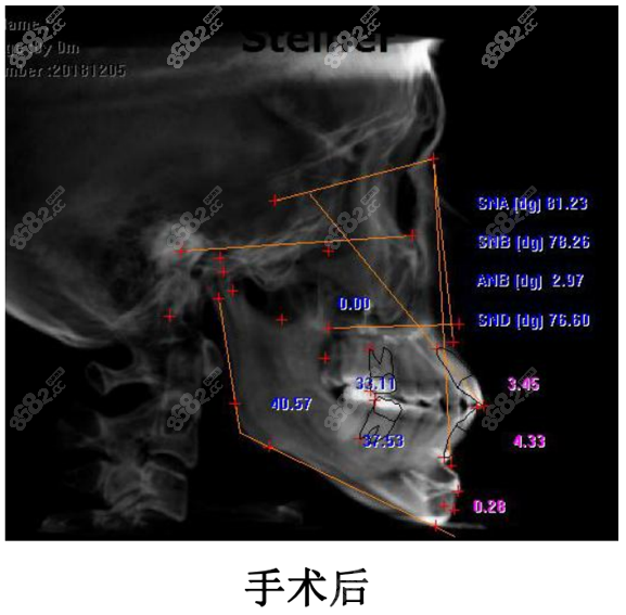 重庆松山医院颏成型怎么样