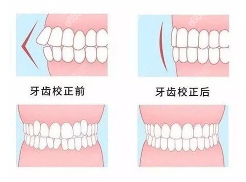 牙齿矫正