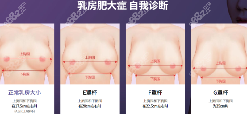 杭州乳房缩小手术哪里好