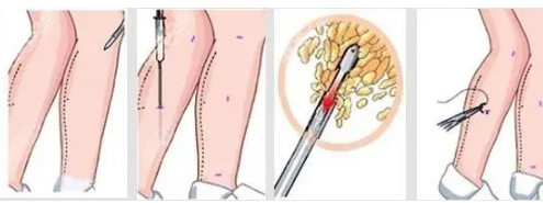 上海卢九宁做腿怎么样