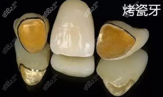 烤瓷牙的图片