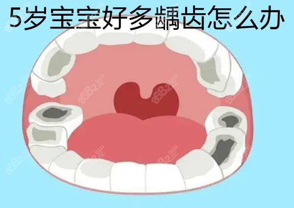 5岁宝宝好多龋齿怎么办