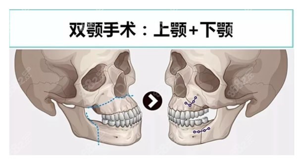 沈阳杏林整形医院双鄂正颌手术过程图解