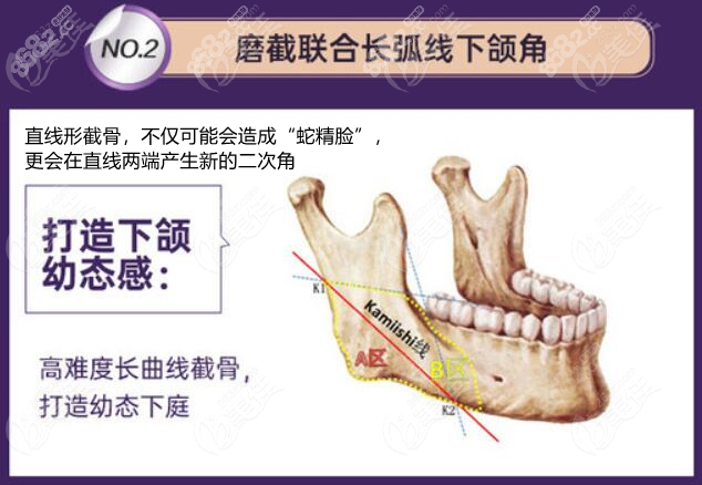 重庆华美磨截长曲线下颌角术