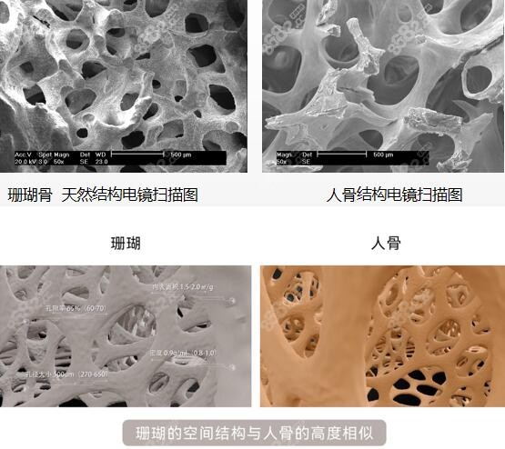 珊瑚骨填充鼻基底优势介绍