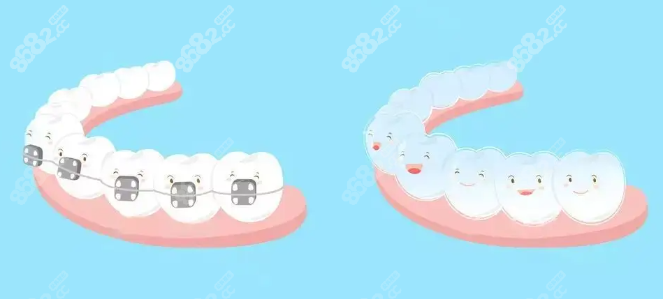 金属托槽与隐形矫正对比示意图