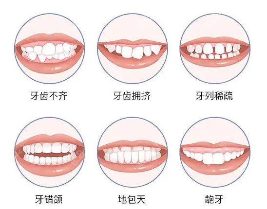 青岛城阳牙齿矫正