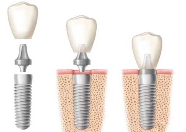 种植牙的结构