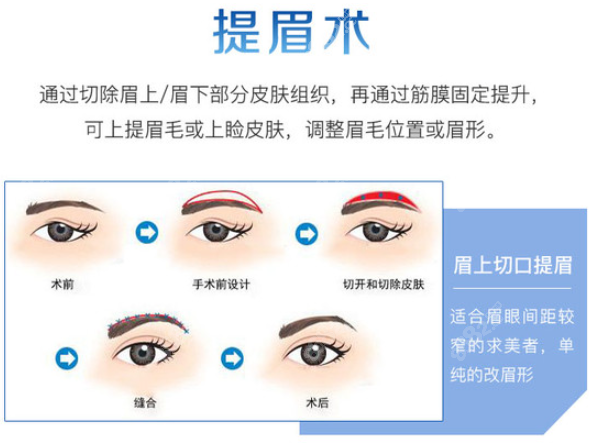 眼皮耷拉做提眉好還是做雙眼皮好