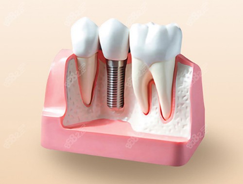 种植牙模型图