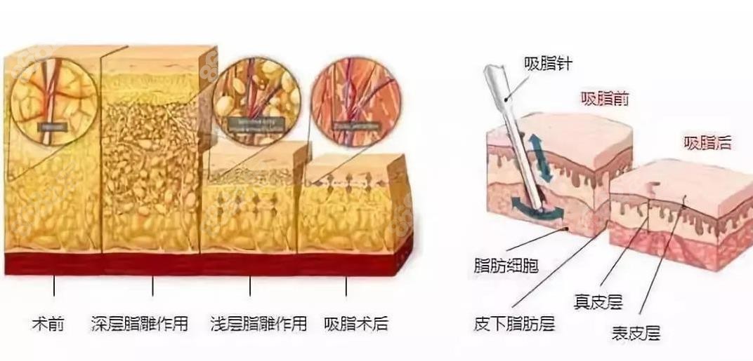 杭州维多利亚整形医院马腾医生吸脂怎么样8682.cc