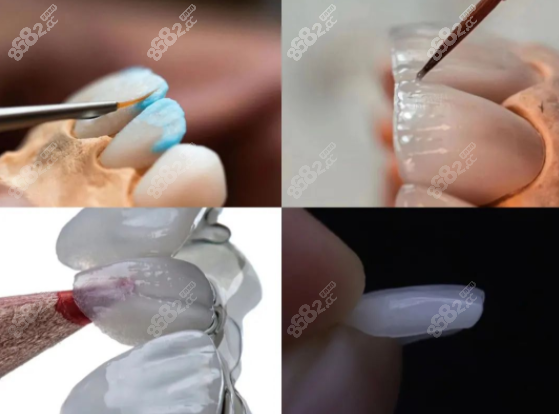 万州牙贴面价格多少钱