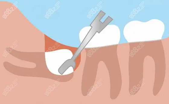拔智齿示意图