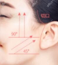 韩国整形和国内差异大吗