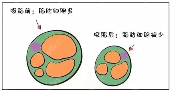 俞国宝医生吸脂技术好吗