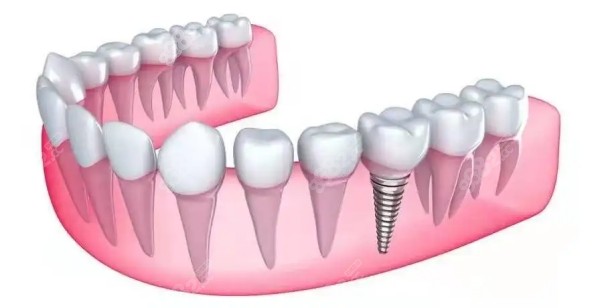 种植牙示意图