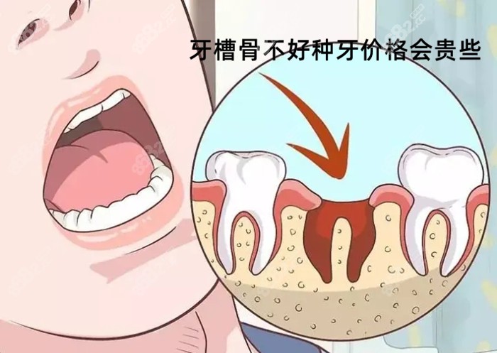 个人本身的牙槽骨不好会导致种牙价格高