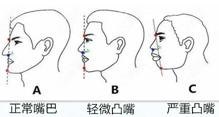 嘴突矫正分两种类型——骨性凸嘴和牙性凸嘴
