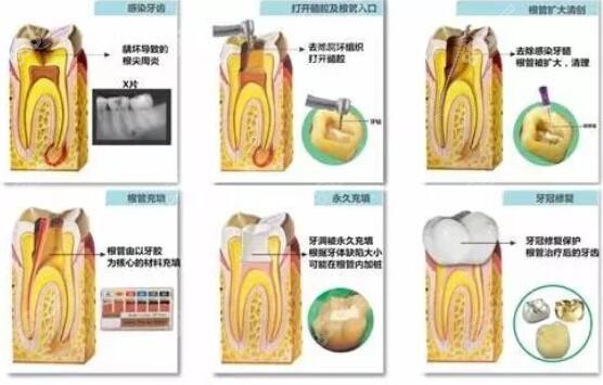 牙烂到什么程度要根管治疗www.8682.cc