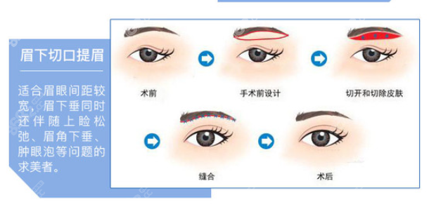 提升上眼皮有什么方法